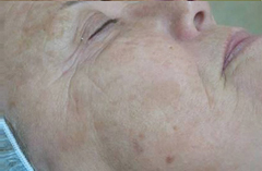 na laserkliniek maastricht