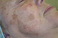 v laserkliniek stein